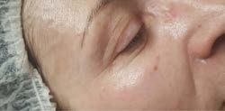 After treatment — Eye area