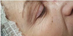 Before treatment — Eye area