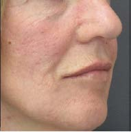 After treatment — Lower face, side view