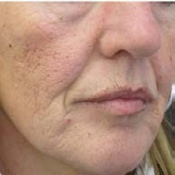 Before treatment — Lower face, side view