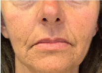 After treatment — Lower face, front view