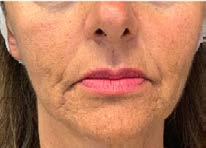 Before treatment — Lower face, front view