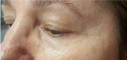 After treatment — Eye area