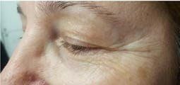 Before treatment — Eye area