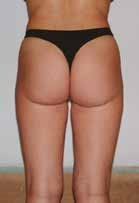 After treatment — Body, rear view