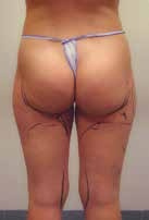 Before treatment — Body, rear view