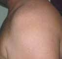 After treatment — Shoulder