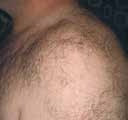 Before treatment — Shoulder