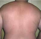 After treatment — Back