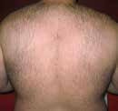 Before treatment — Back