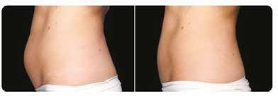 Results after 1 treatment, with a one-month interval