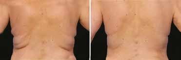 Results after 1 treatment, with a one-month interval