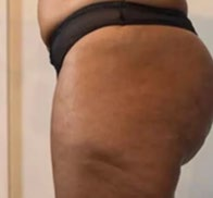 After treatment — Thigh