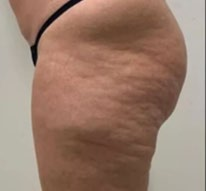 Before treatment — Thigh