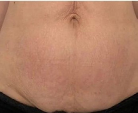 After treatment — Abdomen