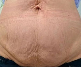 Before treatment — Abdomen