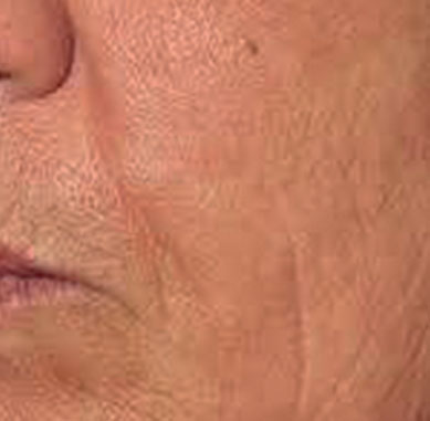After treatment — Cheek