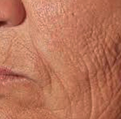 Before treatment — Cheek