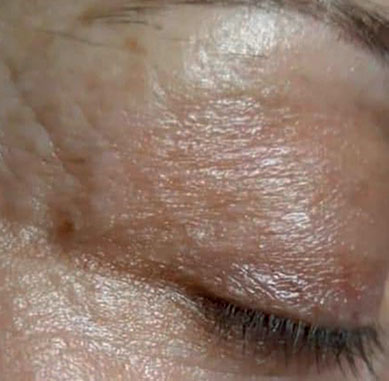 After treatment — Eye area