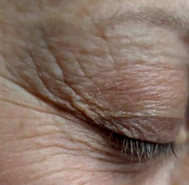 Before treatment — Eye area