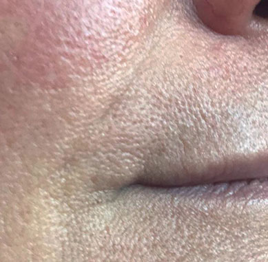 After treatment — Mouth area