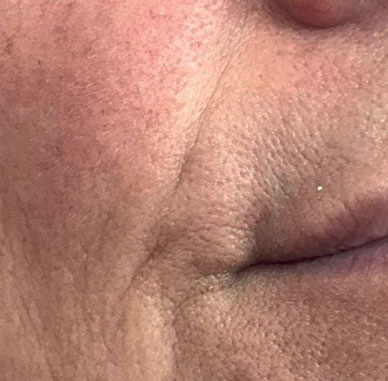 Before treatment — Mouth area