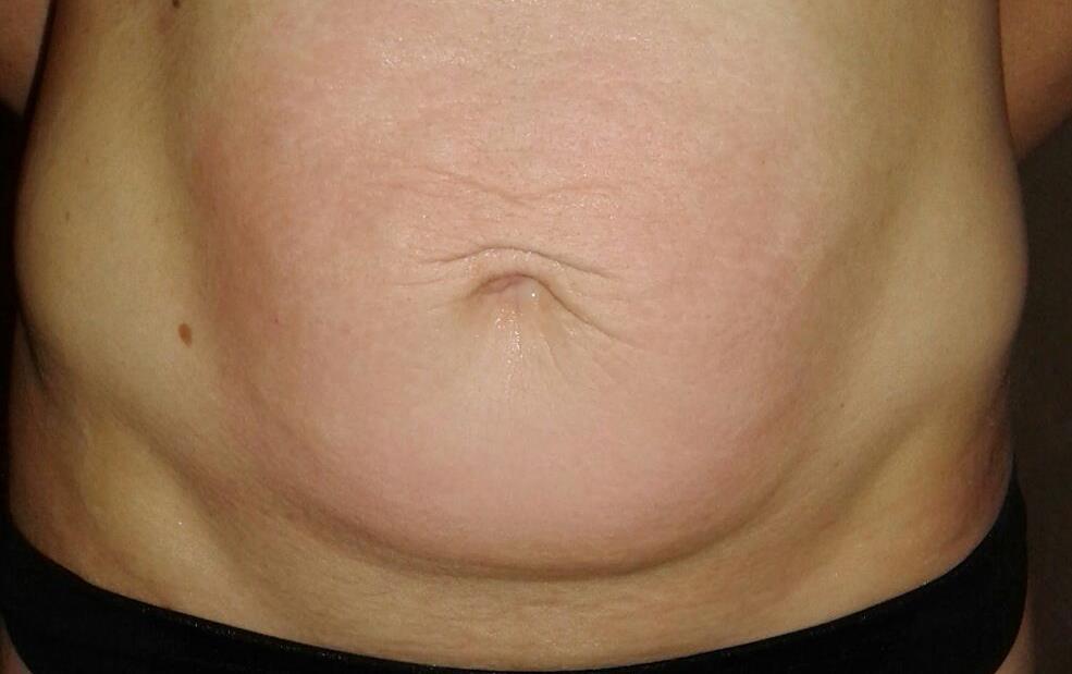 Onda Dinamica® Total Body — Abdomen after treatment