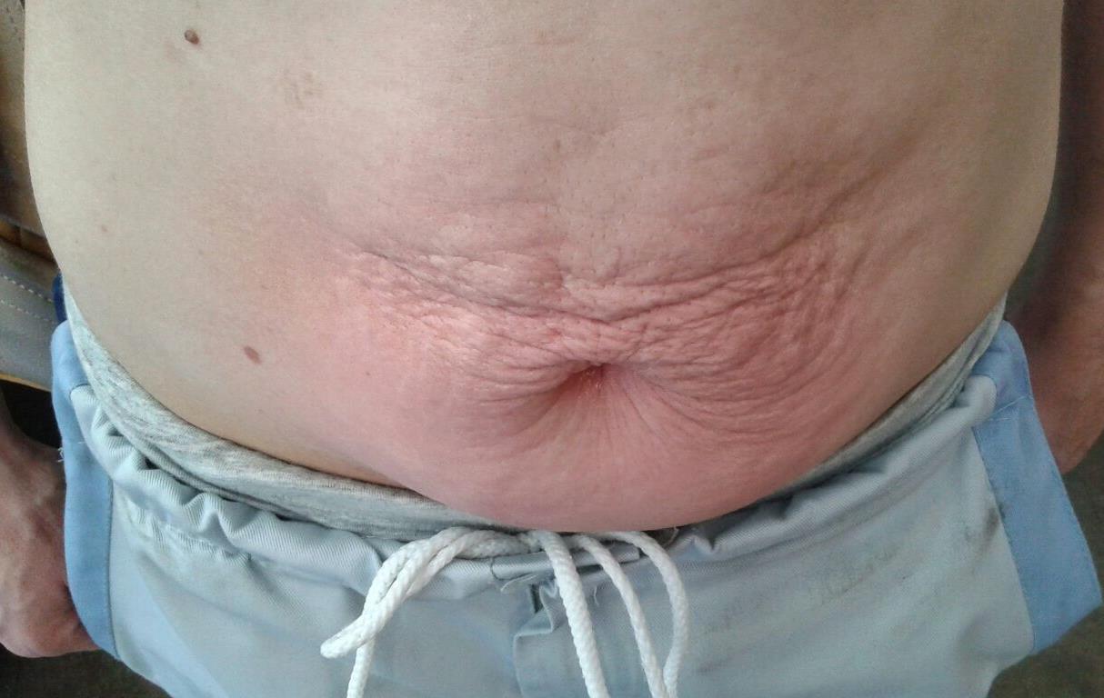 Onda Dinamica® Total Body — Abdomen before treatment