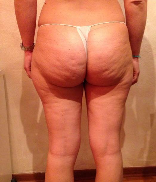 Onda Dinamica® Total Body — Thighs and buttocks before treatment