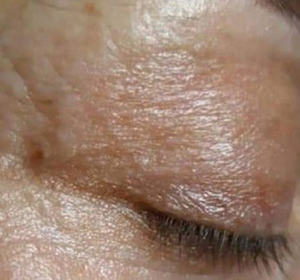 After treatment — Eye area