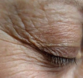 Before treatment — Eye area