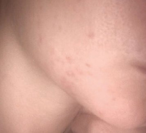 After treatment — Cheek