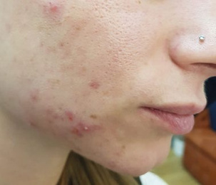 Before treatment — Cheek