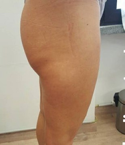 Before treatment — Thigh