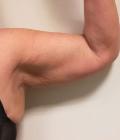 After treatment — Upper arm