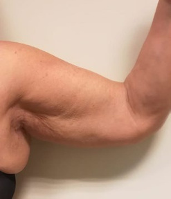 Before treatment — Upper arm